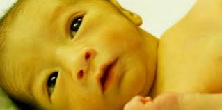 خرید دستگاه فتوتراپی زردی نوزاد - کودک مبتلا به زرد